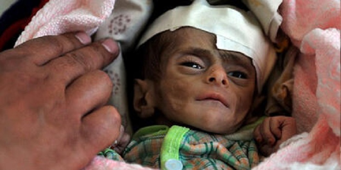 yemende-cocuklar-oluyor