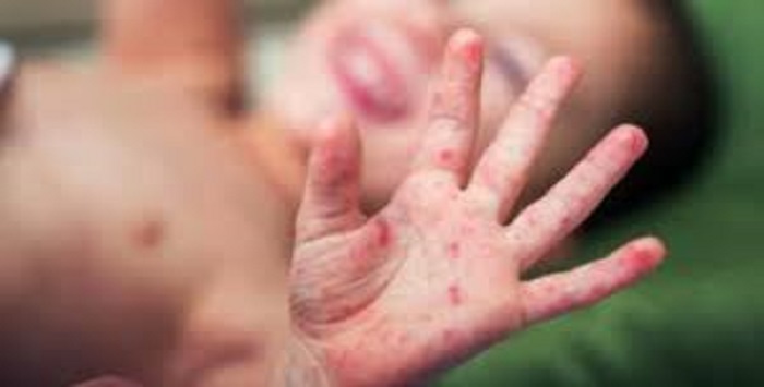 Kızamık, Büyük Şehirler Kurulduğunda Ortaya Çıkmış