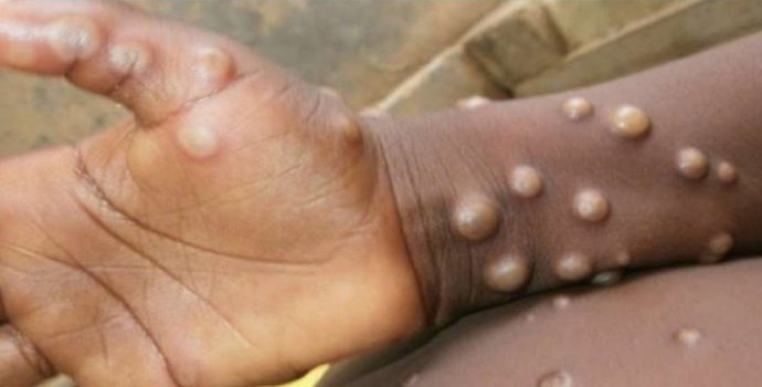 Türkiye’deki ilk maymun çiçeği vakası açıklandı