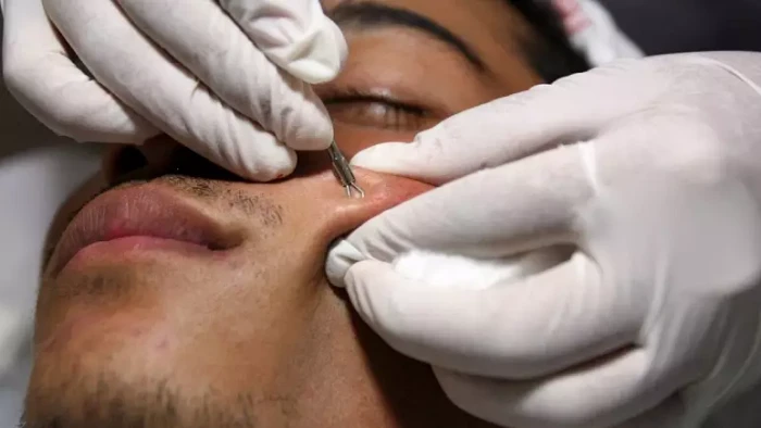 Akne tedavisinde çığır açtığı söylenen ilaç neden Avrupa’da piyasaya sürülmüyor?