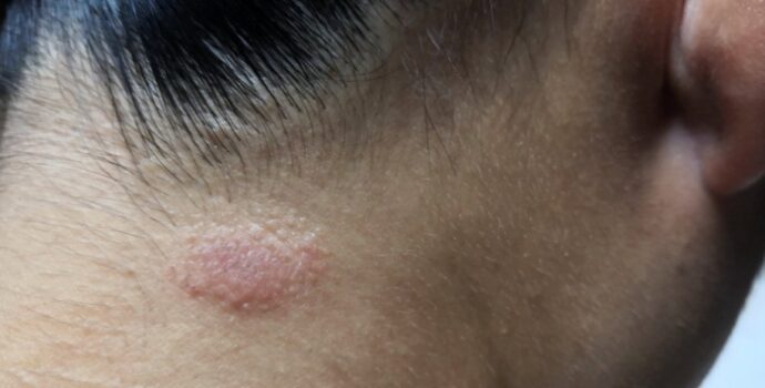 ABD’de ilaca dirençli ilk saçkıran vakaları