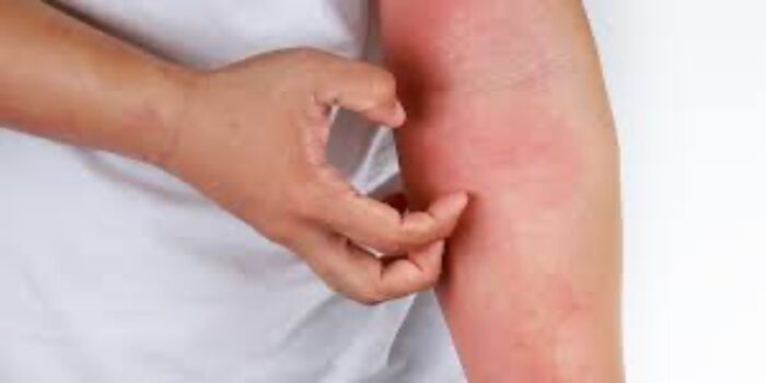 Türkiye’de uyuz vakaları, son 3- 4 yıl içerisinde 30- 40 kat arttı