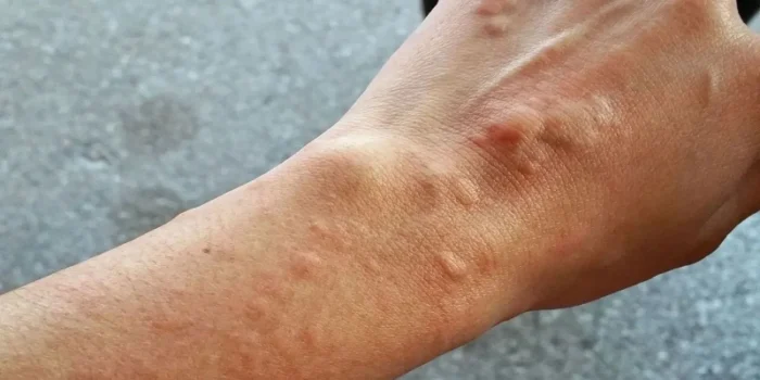 Öğretmen sendikası uyardı: Öğrenciler arasında uyuz hızla yayılıyor