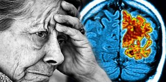 Alzheimer’ı Geciktiren Nadir Genetik Varyant Keşfedildi