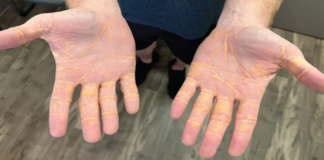 Aşırı Et Tüketiminin Sağlık Üzerindeki Yan Etkileri